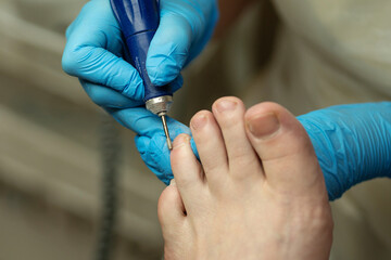 Blue-gloved podiatrist shapes toenails with drill in sterile clinic. Chiropody and podology concept, foot care