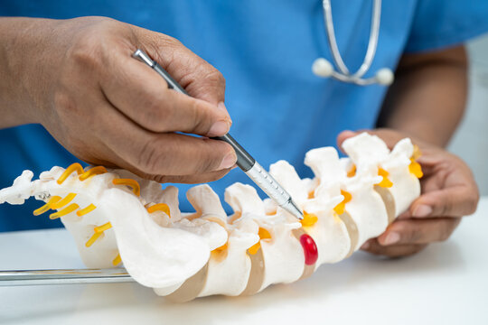 Asian doctor holding spinal nerve and bone model, Lumbar spine displaced herniated disc fragment for treatment medical in the orthopedic department.