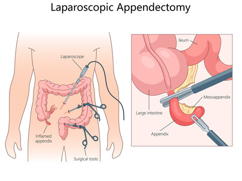 Laparoscopic appendectomy, instruments used and the removal of an inflamed appendix from the large intestine diagram hand drawn schematic raster illustration. Medical science educational illustration