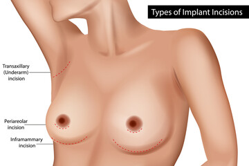 Breast Implant Incision Types Medical Illustration. Vector Diagram of Breast Surgery Incision Options. Cosmetic Surgery Breast Implant Access Points Labeled
