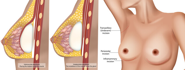 Detailed medical illustration showing two types of breast implant placements—submuscular and subglandular. The locations for breast augmentation surgery, including transaxillary, periareolar, and infr