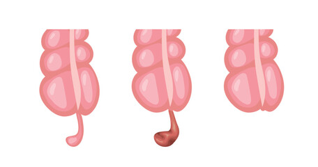 Appendicitis inflammation developing in three stages, from normal appendix to infected appendix