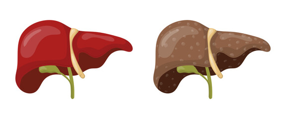 Healthy liver and cirrhotic liver showing cirrhosis medical concept