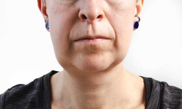 Swollen face from wisdom tooth extraction. Close up of woman with 3 wisdom teeth removed, 1 day after. Cheek swelling from dental surgery, wisdom teeth removal or tooth infection. Selective focus.