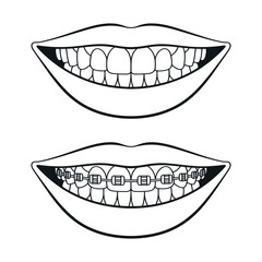 Mouth with teeth and mouth with teeth with braces vector illustration in black and white outline style for dental clinic