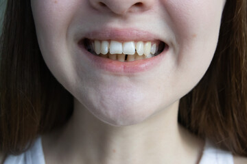 Close up of  woman smile showing dental malocclusion with visible overbite and crooked teeth
