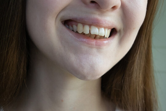 Close-up of a woman smile displaying dental malocclusion with pronounced overbite and misaligned front teeth.
