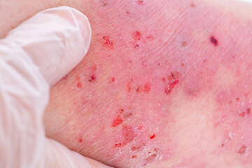 doctor treats large healing wound from on lower leg with scars adult female patient, redness, sores on limbs, scarring skin, concept medical care, health care, human tissue regeneration