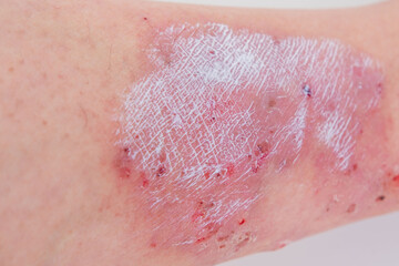 healing wound from on lower leg with scars adult female patient, redness, sores on limb, scarring...