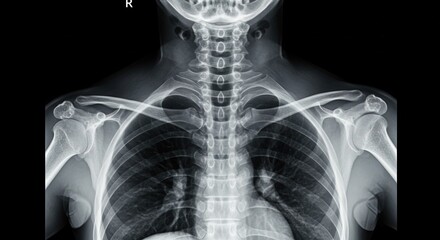 A detailed x ray image showing the chest, neck, and shoulder bone structure.