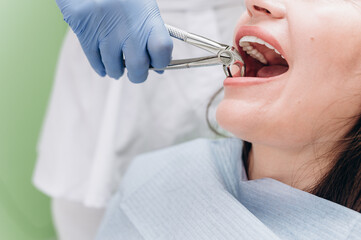 Close-up of a woman's mouth with white teeth during a dental procedure in a clinic.