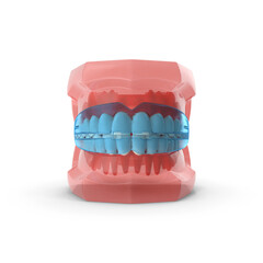 Typodont with Transparent Removable Retainer isolated on transparent background