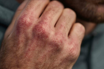 PsoriasisArthritis verstehen Erste Anzeichen und moderne Behandlung 2025