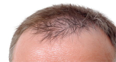 Obraz premium Overhead Closeup of Scalp Micropigmentation Hairline Tattoo Detail Against Transparent Background, Showing Cosmetic Treatment For Hair Loss and Realistic Hair Follicle Simulation