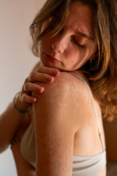 Young woman caresses her shoulder with pigment spots