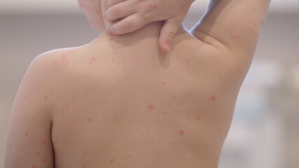 A Child with a Skin Condition chickenpox Relaxing in Natural Light Outdoors, Enjoying the Summer Day