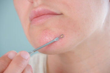 Purulent pimple on a woman's face. A woman uses a skin cleansing tool.
