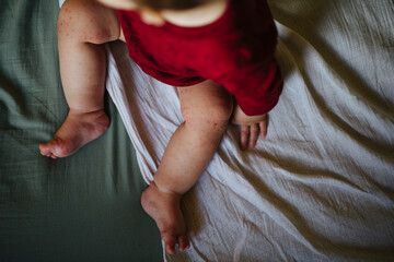 Baby with skin allergy sitting on bed