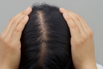 Fototapeta premium Women with hair loss dryness and frizziness.