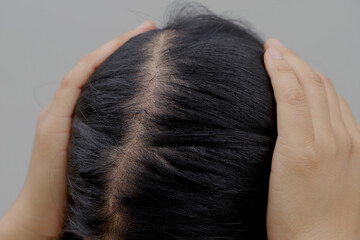 Obraz premium Women with hair loss dryness and frizziness.