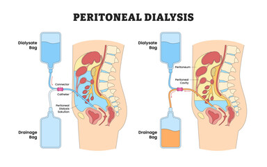 Peritoneal Dialysis Before After Home Care with Dialysate and Drainage Bag, Educational Medical Poster Design Healthcare Scheme, Labeled Catheter, Peritoneum, Connector, Solution, Cavity.