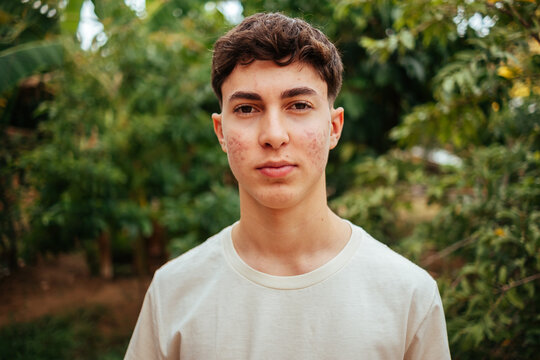 Portrait of a serious teenage boy with acne standing outdoors surrounded by greenery in a calm and natural setting