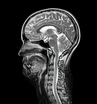 Brain anatomy, 3D illustration and composite MRI