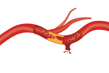 Medical diagram of atherosclerosis and artery damage with blood leakage.