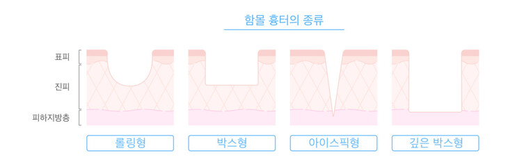 함몰 여드름 흉터의 종류와 피부 단면도 일러스트