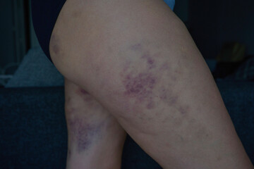 Bruises on the hips and thighs after cellulite treatments
