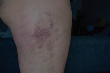 Bruises on the hips and thighs after cellulite treatments