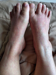 Fototapeta premium Red and mottled skin on the patient's legs is a typical indication of low platelet count (thrombocytopenia) due to dengue fever.