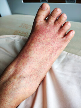 Red and mottled skin on the patient's legs is a typical indication of low platelet count (thrombocytopenia) due to dengue fever.