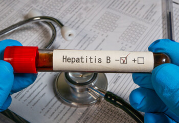 Doctor holding blood sample testing positive for hepatitis b