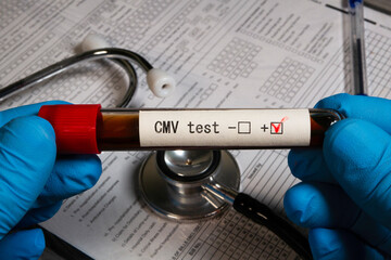 Doctor holding test tube showing positive result for cmv test