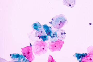 Abnormal squamous epithelial cells on white background view in microscopy.Atypical epithelial cells criteria for pap smear slide cytology.Medical background.