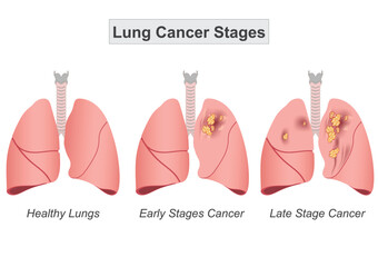 Lung cancer staging helps determine how much the cancer has spread.