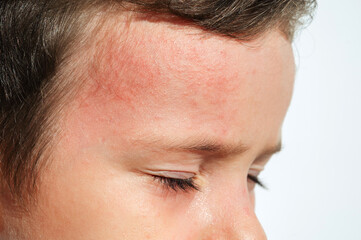 Chicken pox rash spots on child skin close-up. Coxsackie virus on boy face