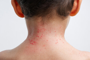 Chicken pox rash spots on child skin close-up. Coxsackie virus on the boy neck