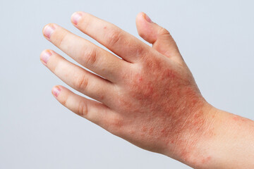 Red rashes spots from Coxsackie virus on child hand close-up. Chicken pox and allergy symptoms on skin on children's body on a white background