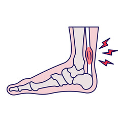 Achilles Tendinitis