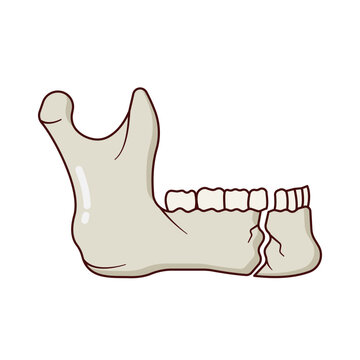 Mandibule Fracture