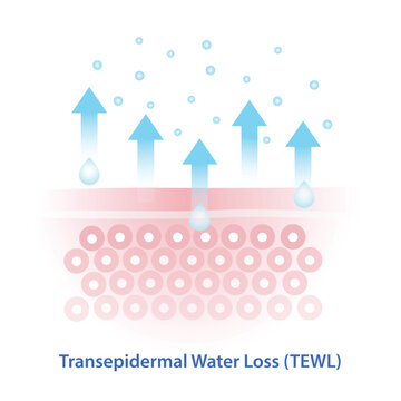 The mechanism of transepidermal water loss illustration on white background. TEWL is the process where water evaporates from the skin&rsquo;s surface, leading to dehydration and compromised skin barrier.