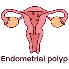 Medical diagram of uterus with endometrial polyp, a benign growth inside uterine lining. Used for gynecology, diagnostics, and reproductive education