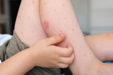 Child scratch body has sensitive itchy skin. Bodily rash. Kid allergy closeup. Little baby scratches eruption. Irritation, hive. Pruritus. Mosquito insect bite. Red from sunburn, Seborrheic Dermatitis