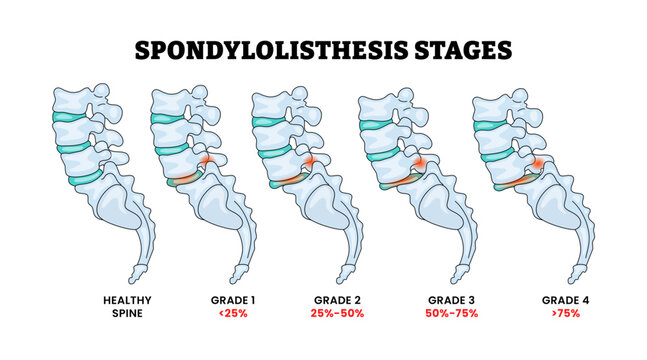 Spondylolisthesis Stages Grade Spine Disease Process Development, Educational Medical Poster Design Healthcare Scheme, Labeled Inflammation Tail Spinal Column Disc Backbone Vertebral Skeleton.