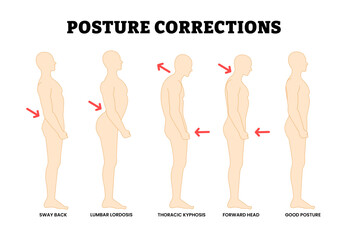 Posture Correction. Spinal Deformities, Incorrect Alignment. Educational Medical Poster Design Healthcare Scheme, Labeled Forward Head, Good Posture, Lumbar Lordosis, Sway Back, Thoracic Kyphosis.
