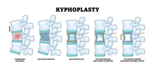 Kyphoplasty Surgery for Spinal Fractures Procedure. Educational Medical Poster Design Healthcare Scheme, Labeled Balloon, Inserted, Kyphoplasty, Removed, Cement, Compressed, Vertebrae, Hardens 