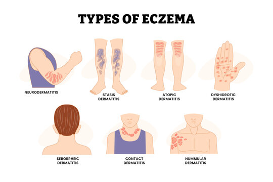Types of Dermatitis or Eczema Types Itchy, Inflamed Skin, Dermatology, Educational Medical Poster Design Healthcare Scheme, Atopic, Contact, Dyshidrotic, Neurodermatitis, Nummular, Seborrheic, Stasis.