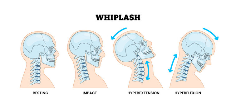 Whiplash Types, Head Skull Bones, Neck Injury and Spinal Trauma, Educational Medical Poster Design Healthcare Scheme, Labeled Hyperextension, Hyperflexion, Impact, Resting, Whiplash.